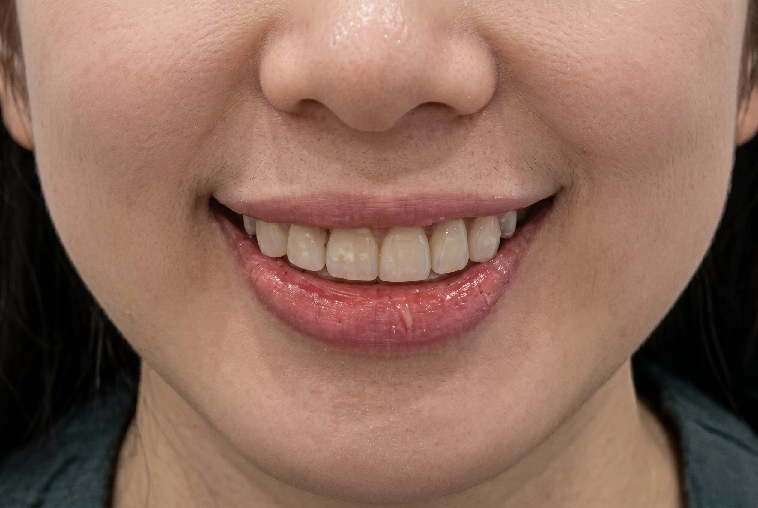 Smile Makeover - After